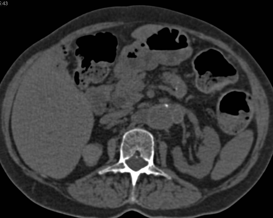 Aortic Aneurysm Repair with Reimplanted Left Renal Artery - CTisus CT Scan