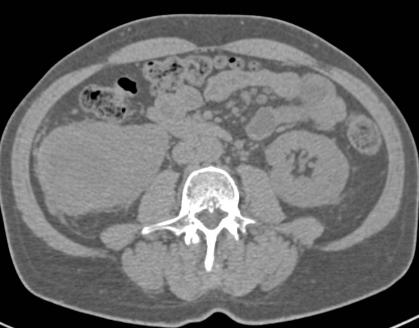 Cystic Renal Cell Carcinoma Shown in Multiple Phases - CTisus CT Scan