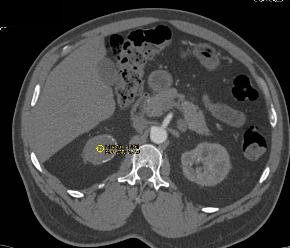 Partially Calcified Complex Renal Cyst - CTisus CT Scan