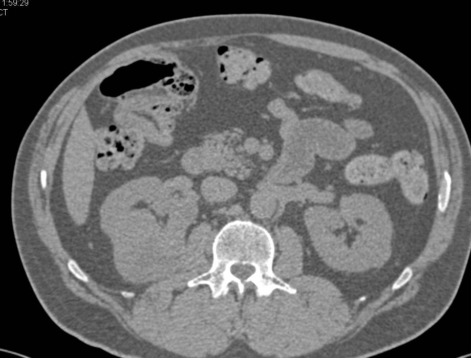 Multiphase Display of a Renal Cell Carcinoma - CTisus CT Scan