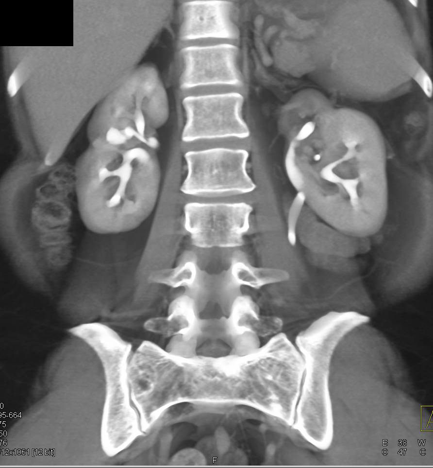 CT Urogram with Duplicated Collecting Systems and Blunted Calyces - CTisus CT Scan