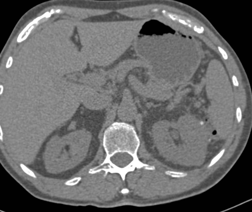 Renal Artery Pseudoaneurysm Following Radiofrequency Ablation (RFA) for Renal Cell Carcinoma - CTisus CT Scan
