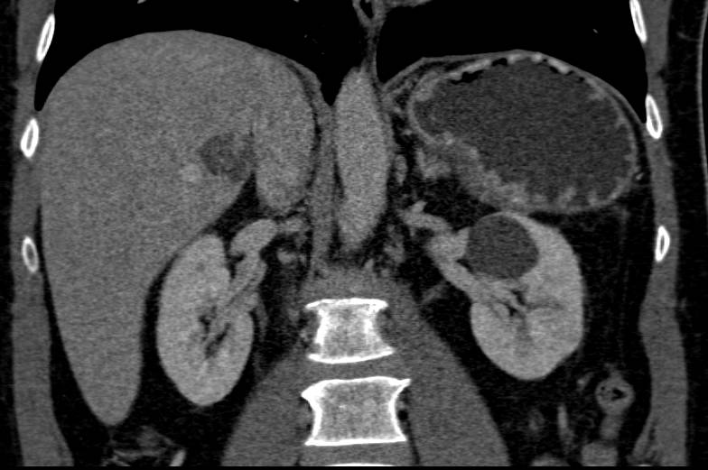 Subtle Vascular Renal cell Carcinoma in Lower Pole of Left Kidney - CTisus CT Scan