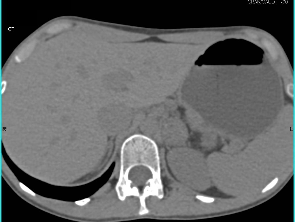 Cystic Renal Cell Carcinoma with Adrenal Metastases - CTisus CT Scan