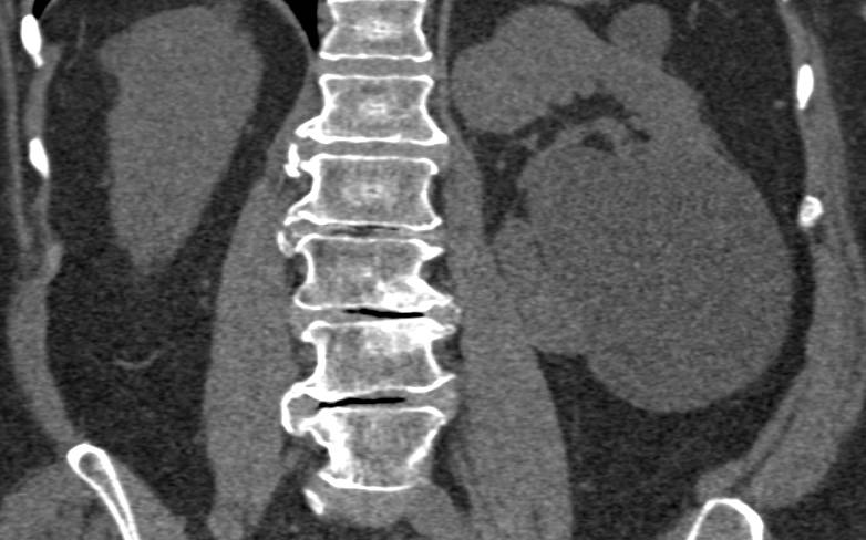 Simple Renal Cyst - CTisus CT Scan