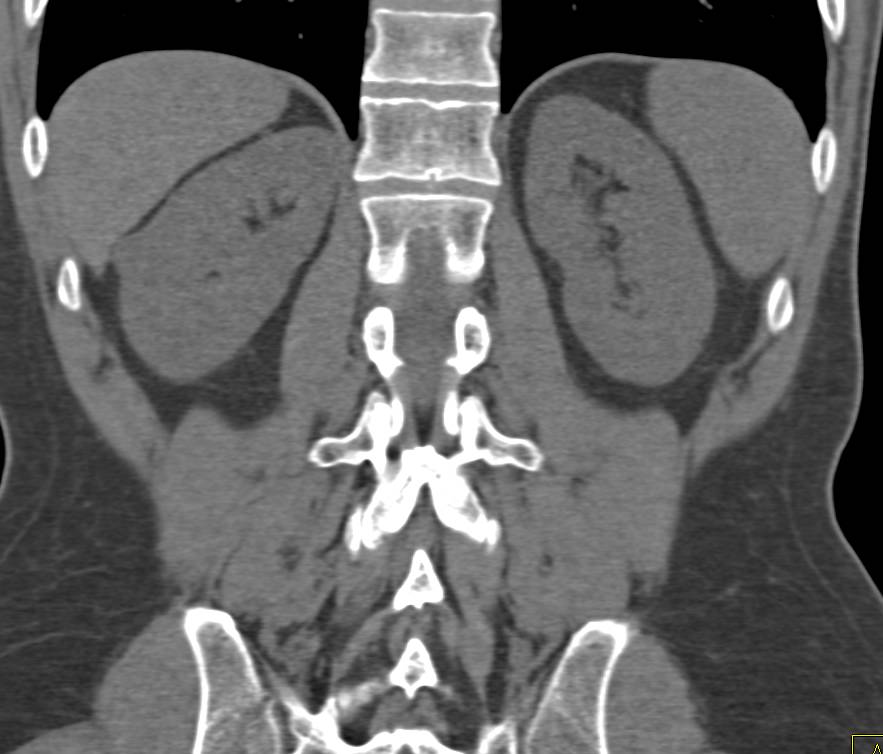 1 cm High Density Cyst Right Kidney with Full Image Sequence - CTisus CT Scan