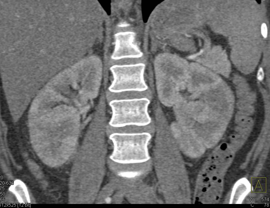 Acute Pyelonephritis with Patchy Nephrogram Best Seen on Late Phase Imaging - CTisus CT Scan