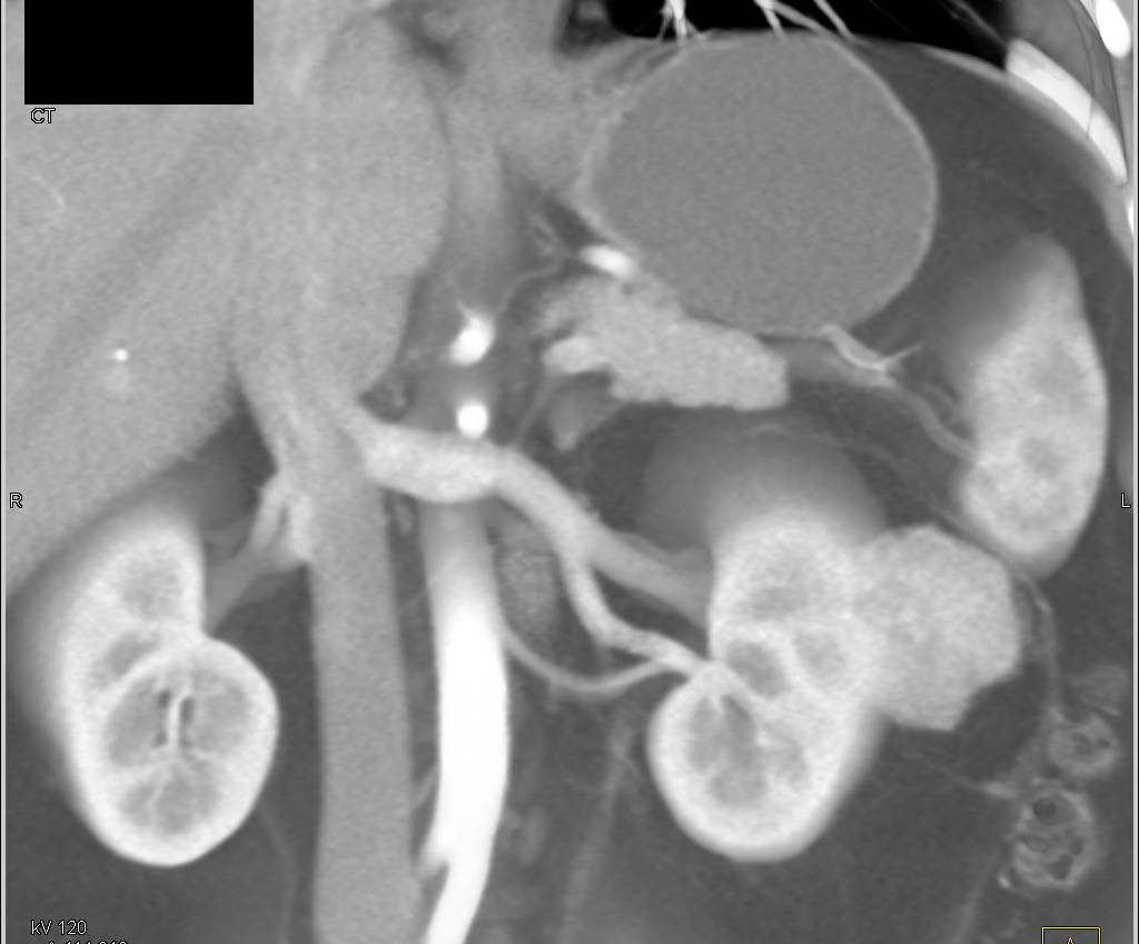 Renal Cell Carcinoma that is Vascular - CTisus CT Scan