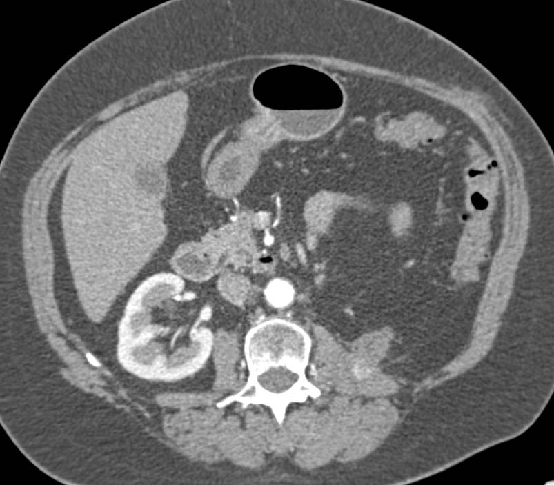 Recurrent Renal Cell Carcinoma Metastatic to the Psoas Muscle - CTisus CT Scan