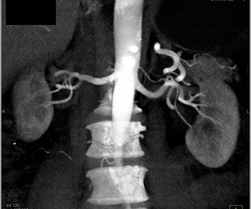 Renal Donor with 2mm Accessory Renal Artery - CTisus CT Scan