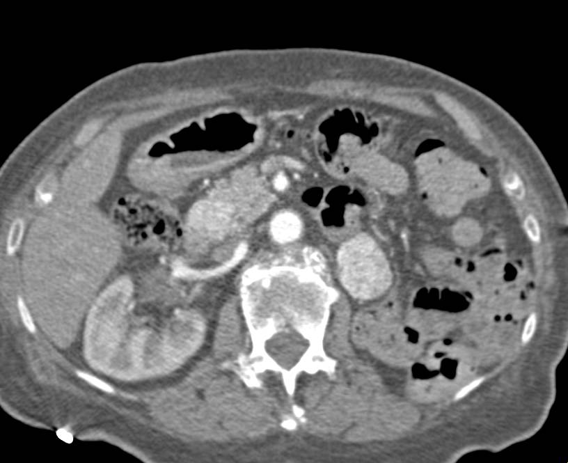 Recurrent Renal Cell Carcinoma Metastatic to the Pancreas as well as Tumor in the Contralateral Kidney - CTisus CT Scan