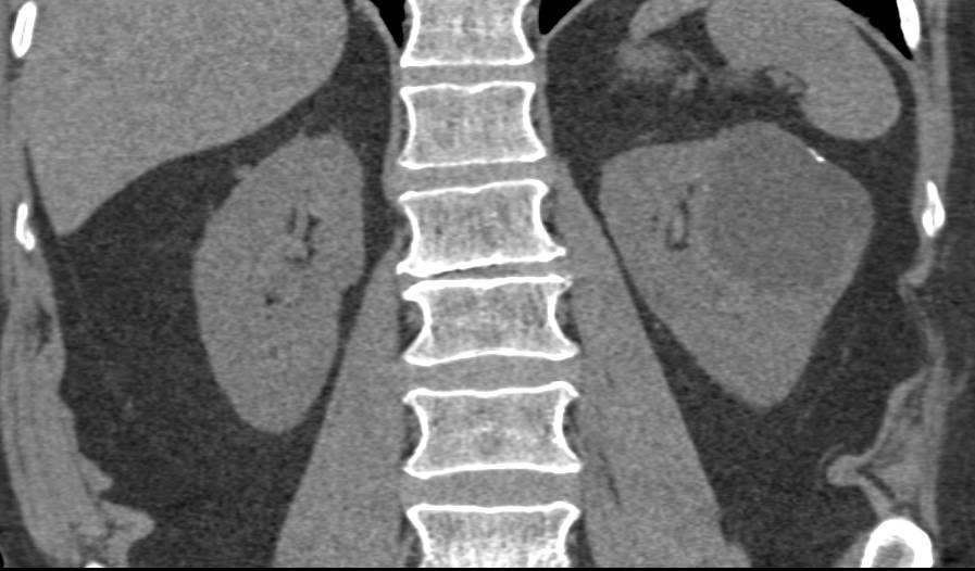 1 cm Right Renal Cell Carcinoma and Simple Left Renal Cyst with Rim Calcification - CTisus CT Scan