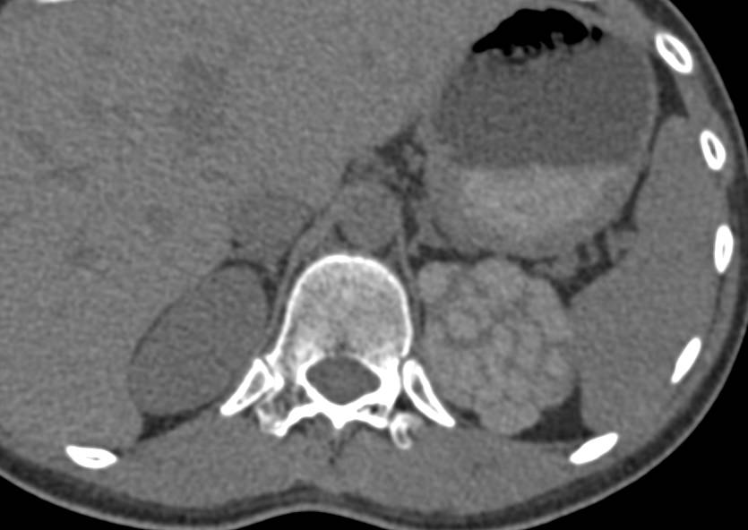 Unusual Appearance of the Kidney with Diffuse Calcifications on Non-contrast Scans and Patchy Enhancement on Arterial and Venous Phase Images - CTisus CT Scan