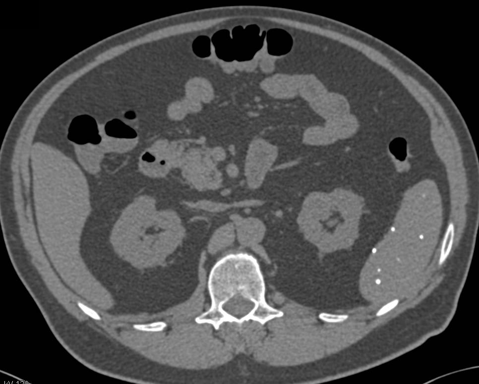 Subtle 2 cm Renal Cell Carcinoma Best Seen on the Delayed Phase Imaging - CTisus CT Scan