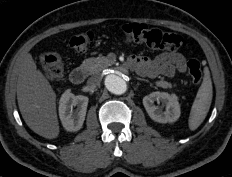 Aortic Dissection with Stents in the Renal Arteries. Renal Arteries Arise off the True Lumen - CTisus CT Scan