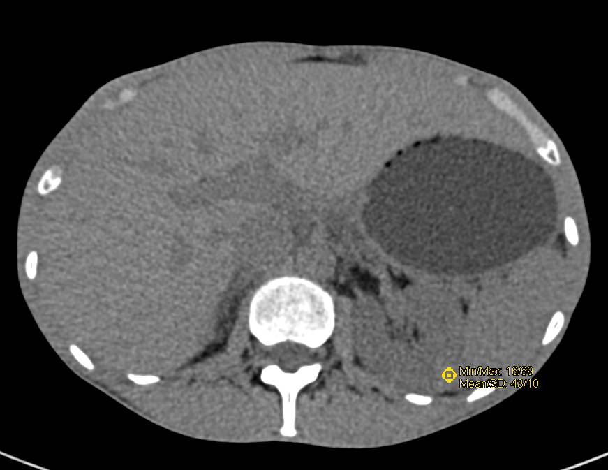 High Density Renal Cyst - CTisus CT Scan