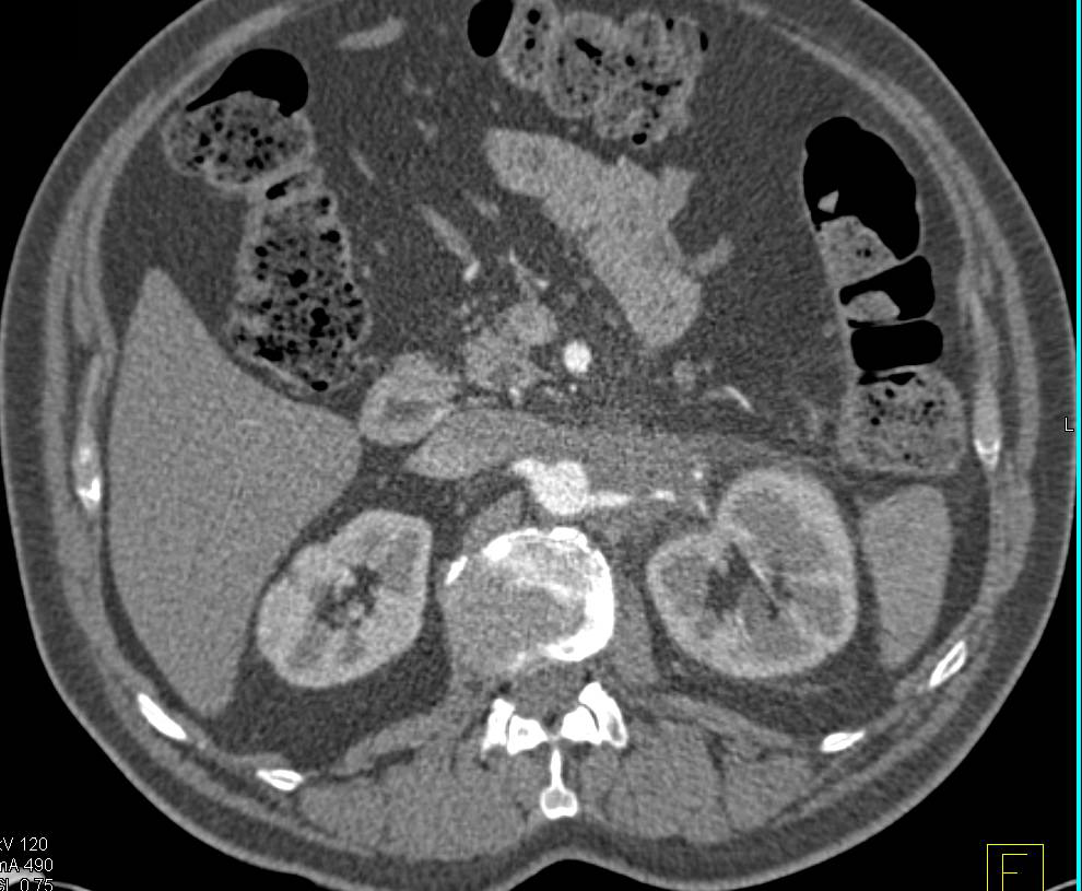 Lymphoma Infiltrates the Left Renal Artery and Hilum - CTisus CT Scan