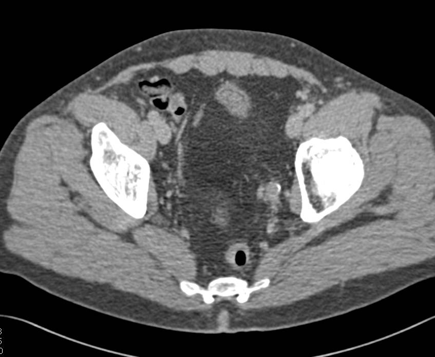 Transitional Cell Carcinoma of Distal Left Ureter - CTisus CT Scan