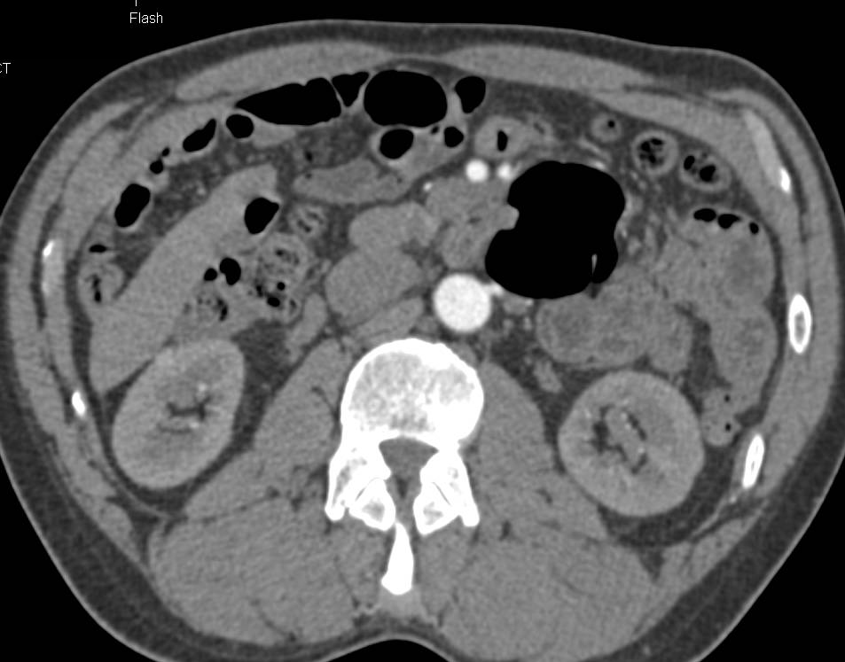 <1cm Right Renal Cell Carcinoma - CTisus CT Scan