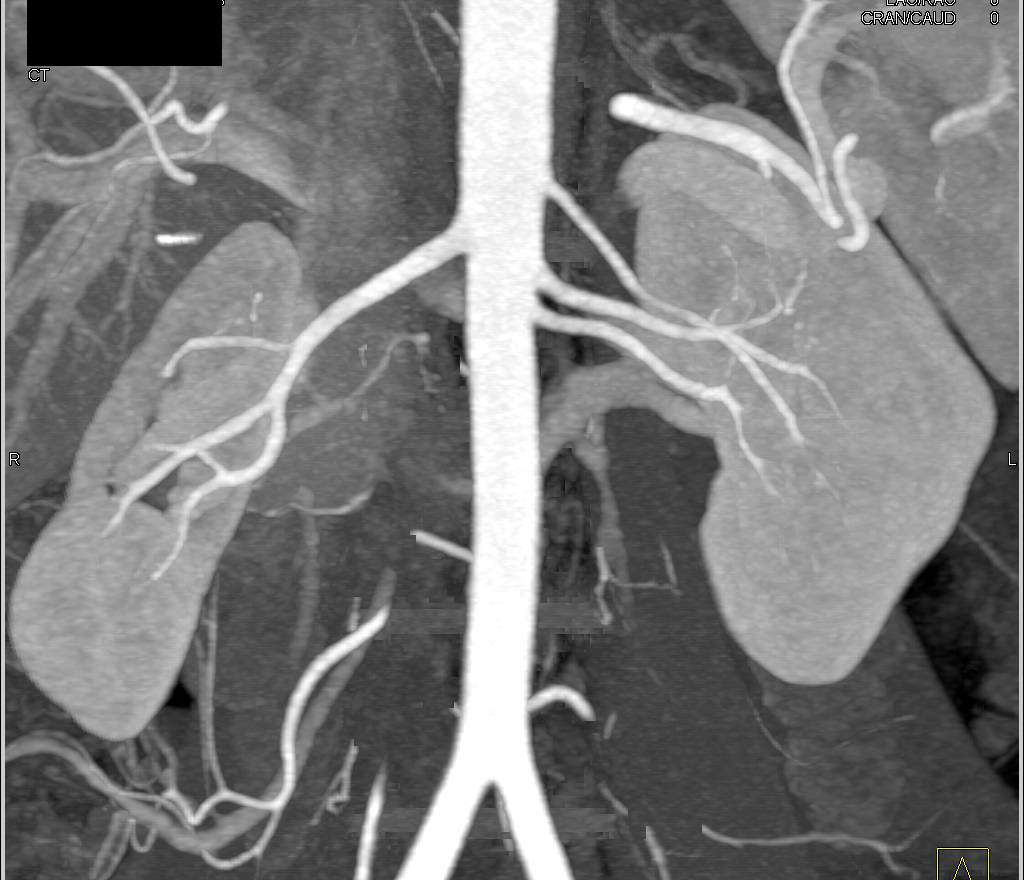 CT Mapping for a Potential Renal Donor - CTisus CT Scan