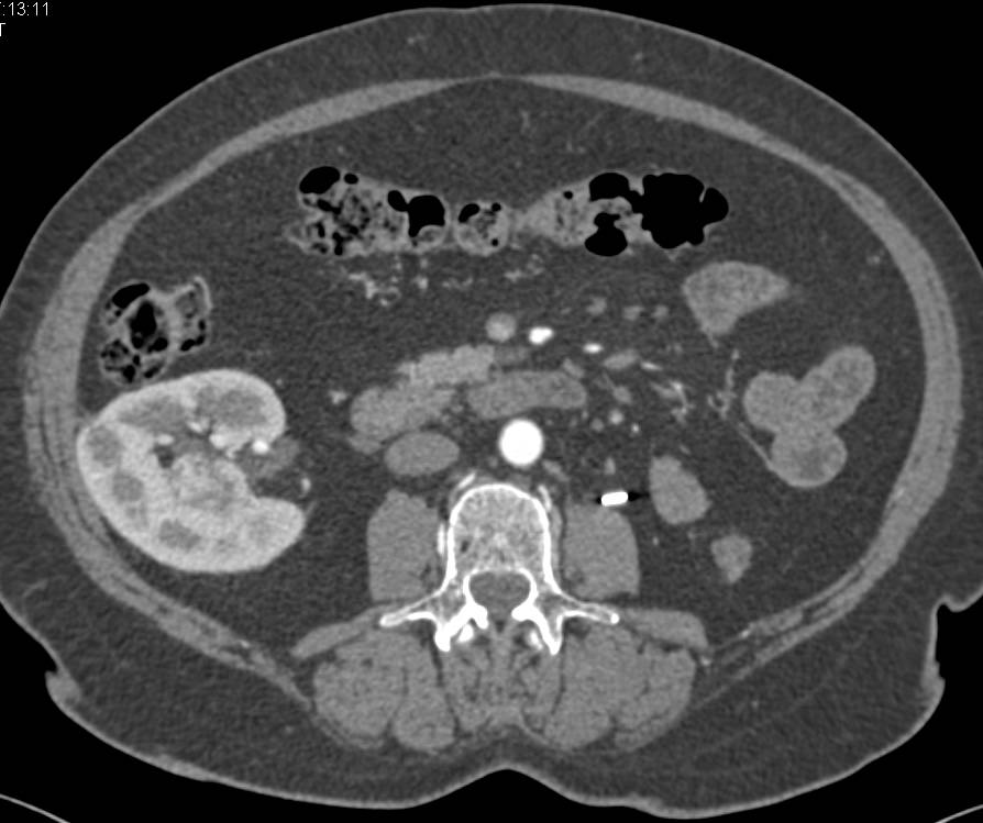 2 cm Right Papillary Renal Cell Carcinoma in a Patient with Prior Left Nephrectomy for Renal Cell Carcinoma - CTisus CT Scan