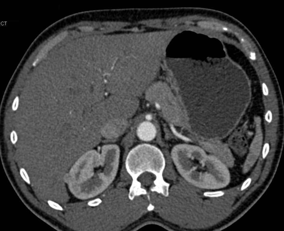 Bilateral Spontaneous Renal Cell Carcinomas - CTisus CT Scan