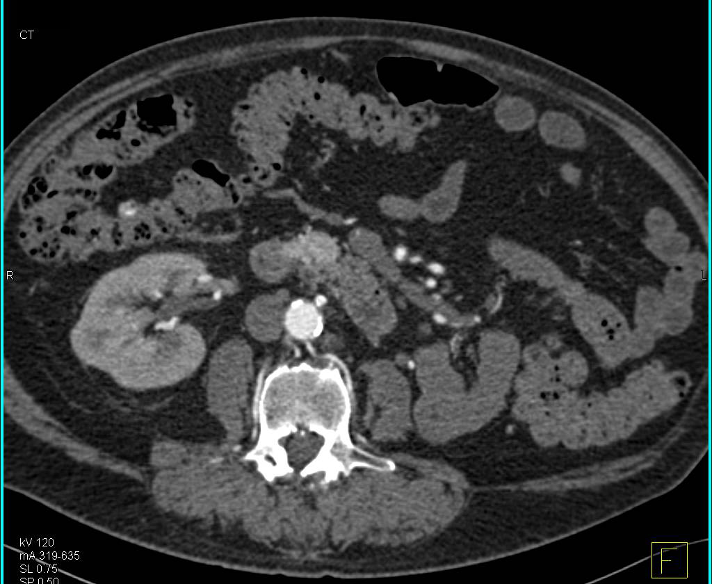 Recurrent Renal Cell Carcinoma Metastatic to the Pancreas - CTisus CT Scan