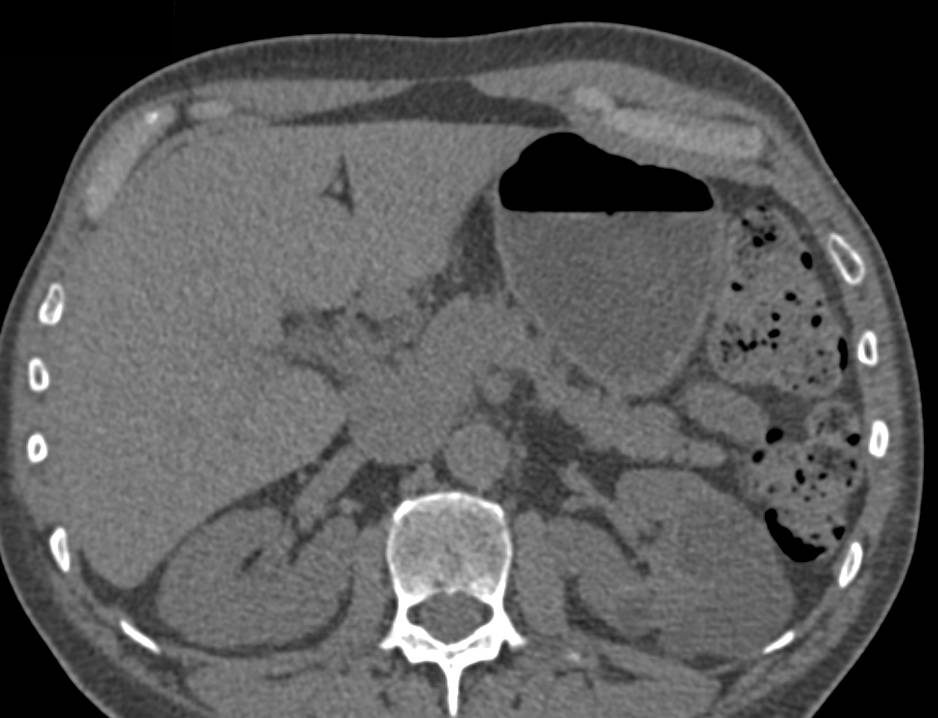 Complex Cyst Left Kidney with Septations - CTisus CT Scan