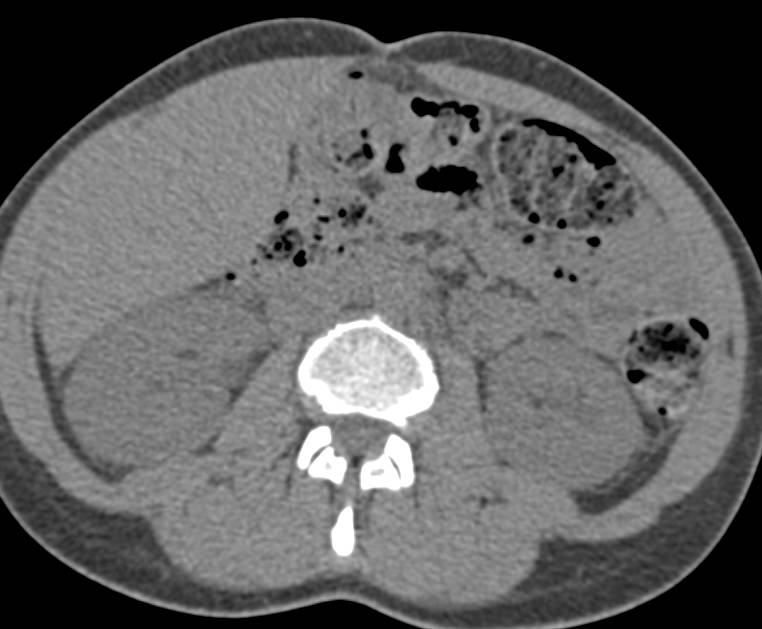 Duplicated and Dilated Left Renal Pelvis, Collecting System and Ureter - CTisus CT Scan