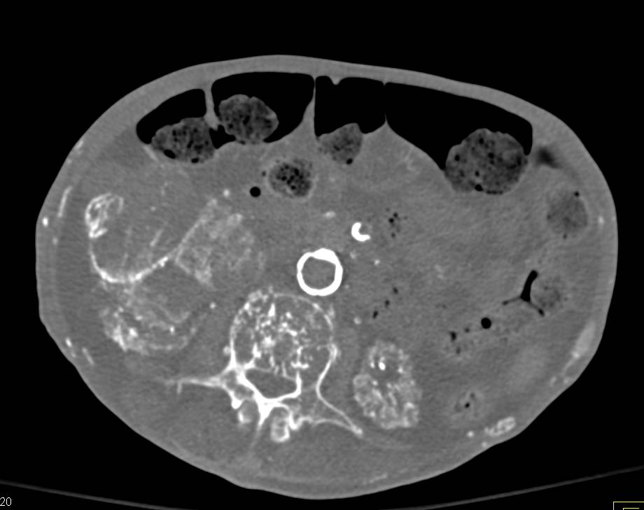 End Stage Renal Disease (ESRD) with Renal Osteodystrophy - CTisus CT Scan