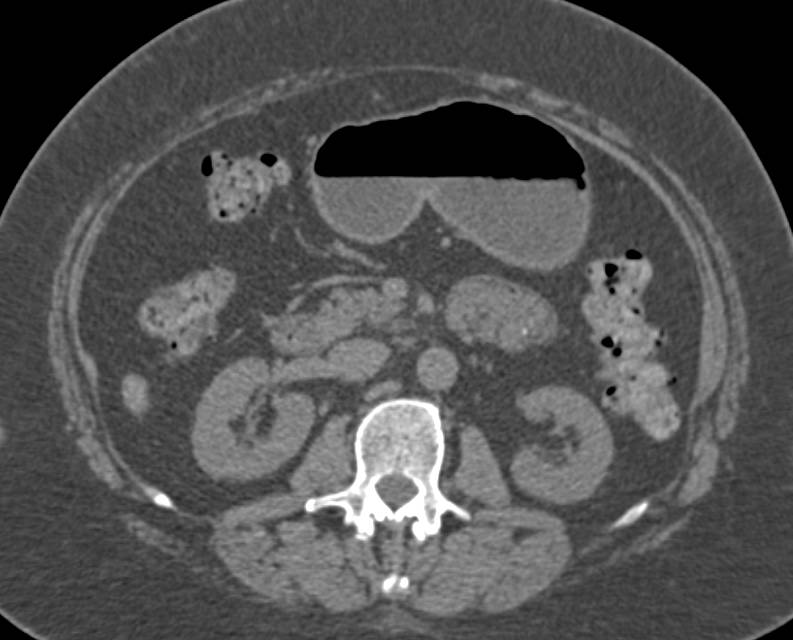 Subtle Carcinoma Left Kidney - CTisus CT Scan