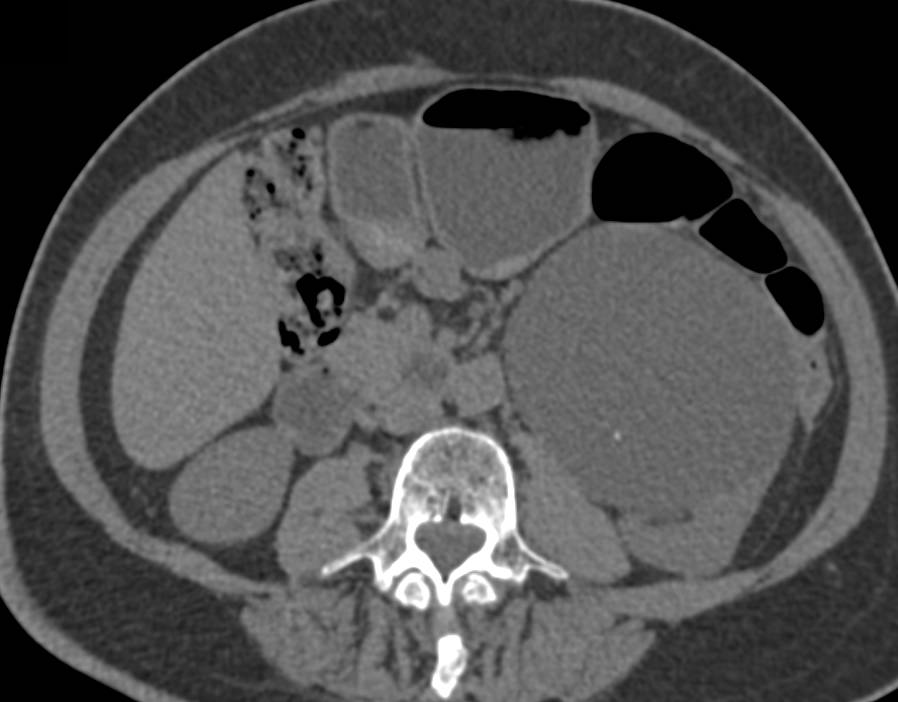 Complex Renal Cyst with Septations - CTisus CT Scan