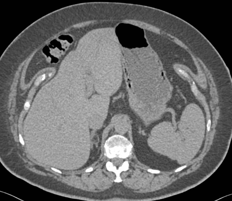 Renal Cell Carcinoma Metastatic to the Contralateral Kidney - CTisus CT Scan