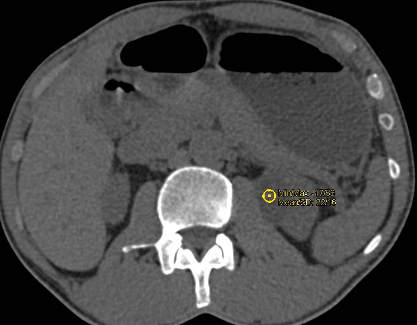 Papillary Renal Cell carcinoma with Mild Enhancement - CTisus CT Scan