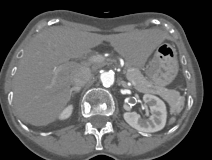 Left Renal Artery Aneurysm - CTisus CT Scan