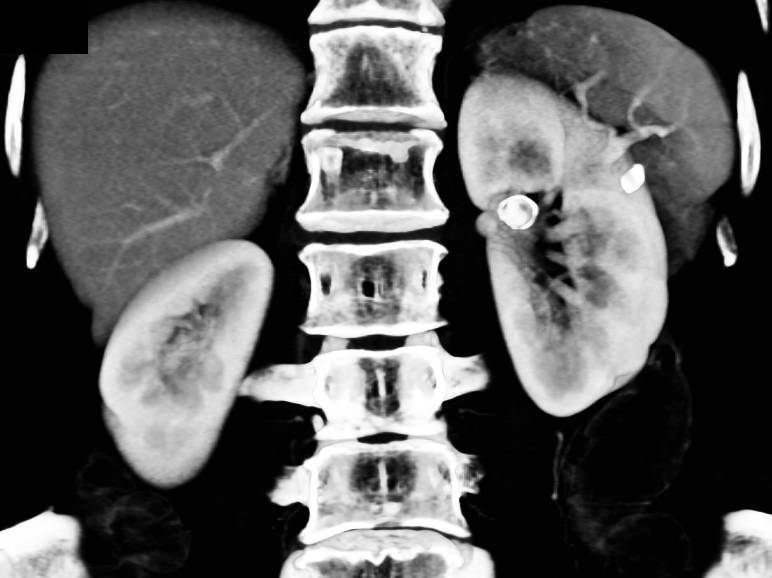 Renal (left) and Splenic Artery Aneurysms as Incidental Findings in a Patient with Pelvic Congestion Syndrome - CTisus CT Scan