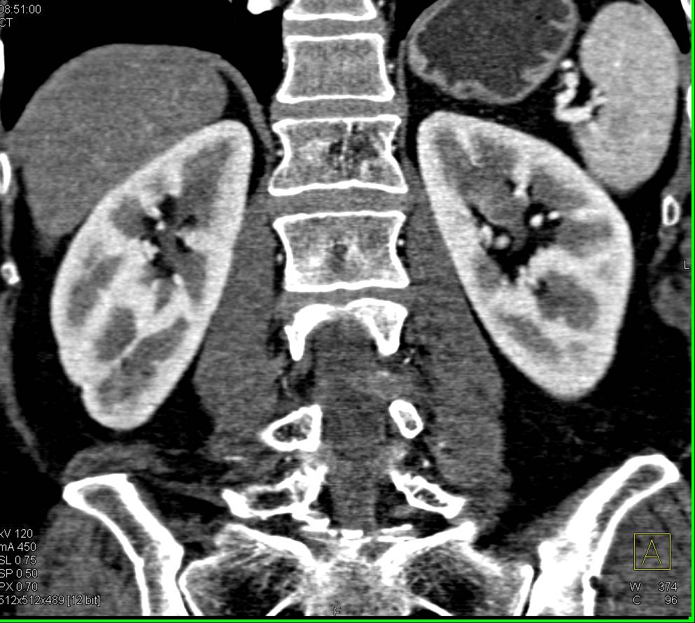 Incidental Left Transitional Cell Carcinoma in a Patient With Pancreatic Cancer - CTisus CT Scan