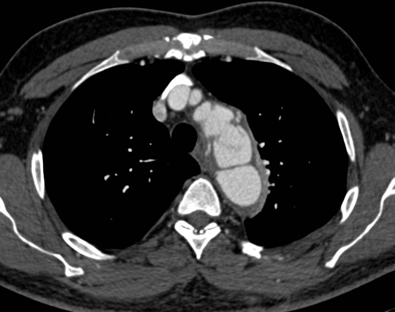 Aortic Dissection with Stents Place in the Renal Arteries Bilaterally - CTisus CT Scan