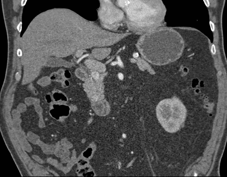 Metastatic Renal Cell Carcinoma to the Pancreas with Vascular Metastases - CTisus CT Scan