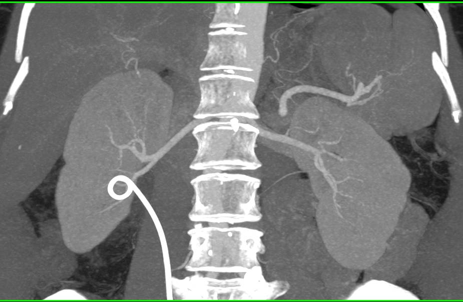 Right Ureteropelvic Junction (UPJ) with Stent in Place - CTisus CT Scan