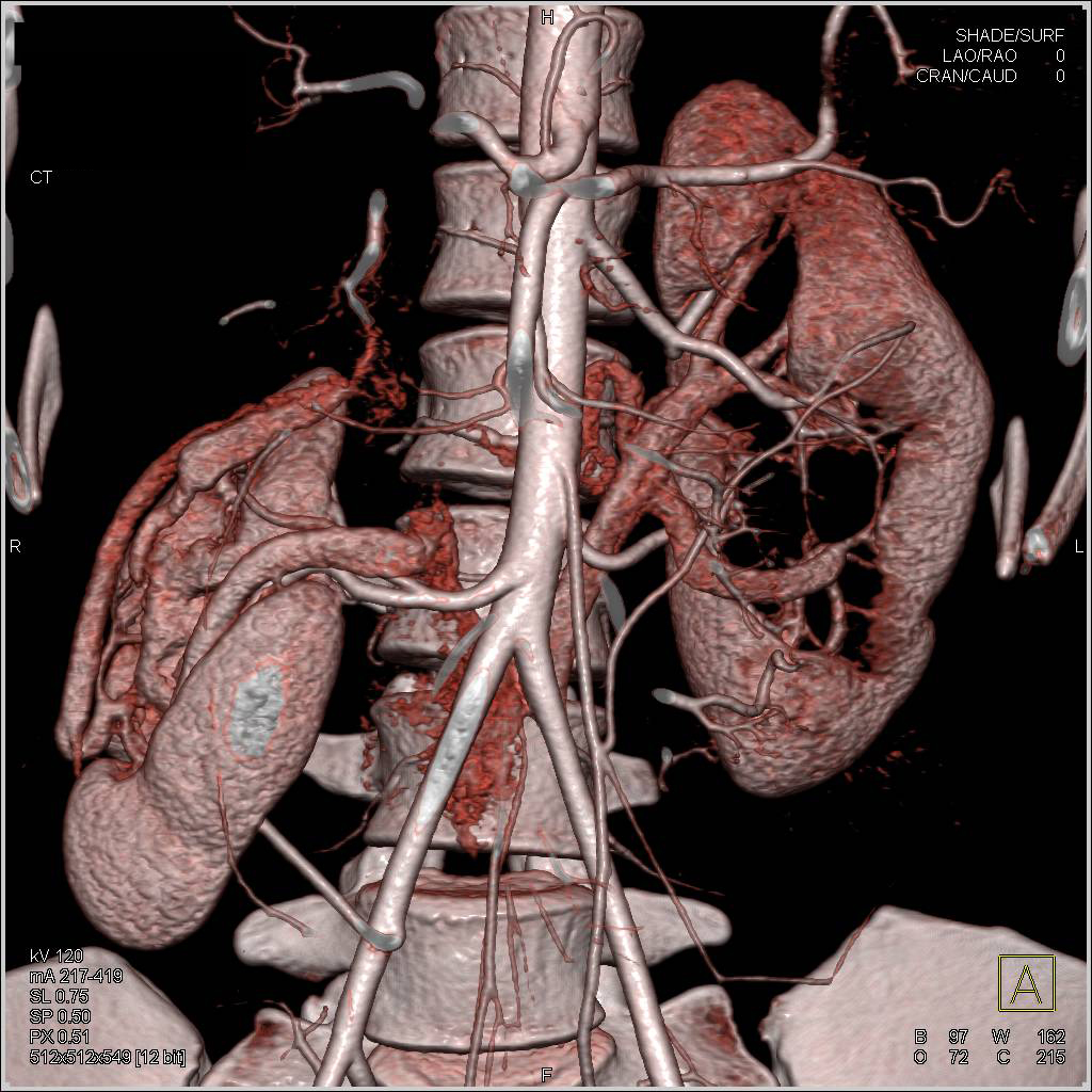 Unusual case with Malrotated Right Kidney and Dilated Calyces Left Kidney - CTisus CT Scan