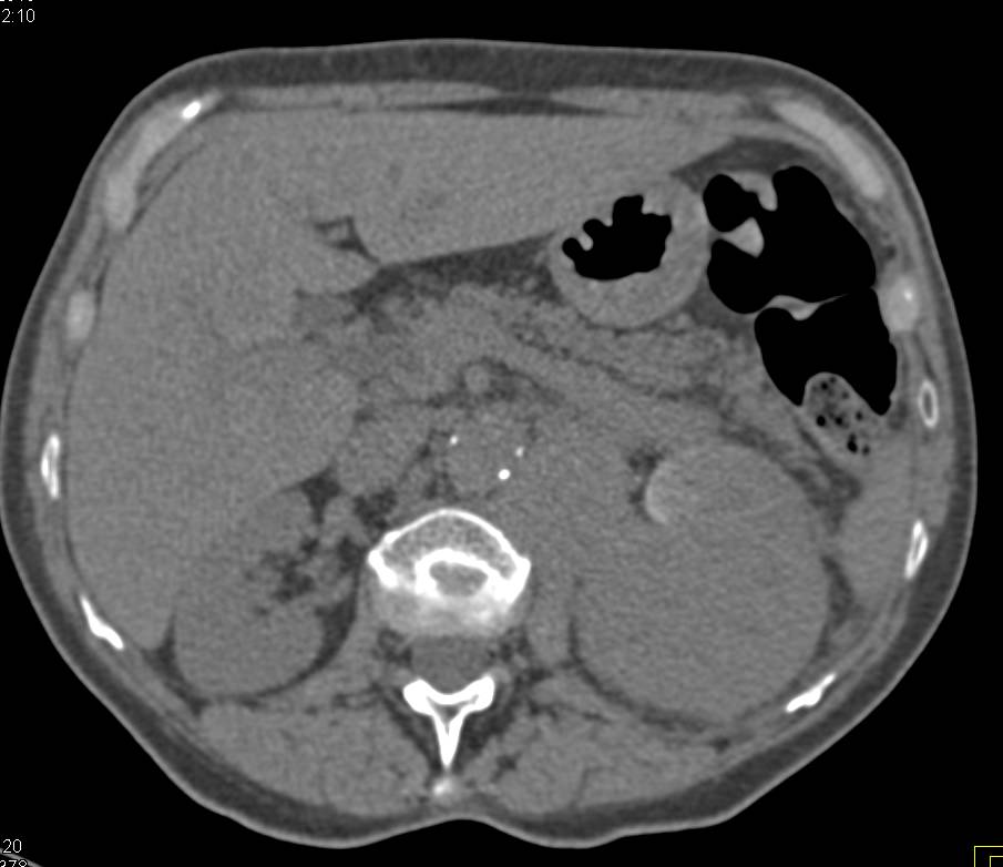 Transitional Cell Carcinoma Left Kidney in Multiple Phases - CTisus CT Scan