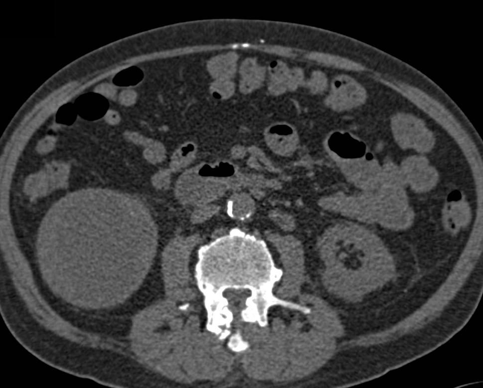 Cystic Renal Cell Carcinoma. See the Subtle Cyst Wall Enhancement - CTisus CT Scan