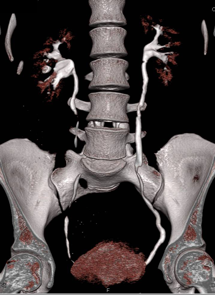 Transitional Cell Carcinoma of Proximal Third of the Left Ureter - CTisus CT Scan