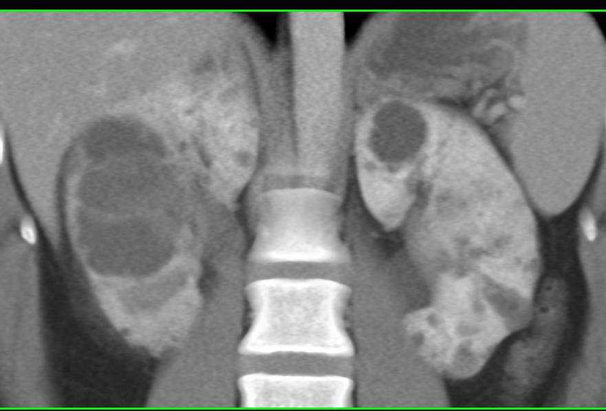 Infected Cyst in the Right Kidney - CTisus CT Scan