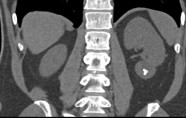 Chronic Pyelonephritis Left Kidney Lower Pole with Blunted Calyces Send Best on 3D VRT Excretory Phase Images - CTisus CT Scan