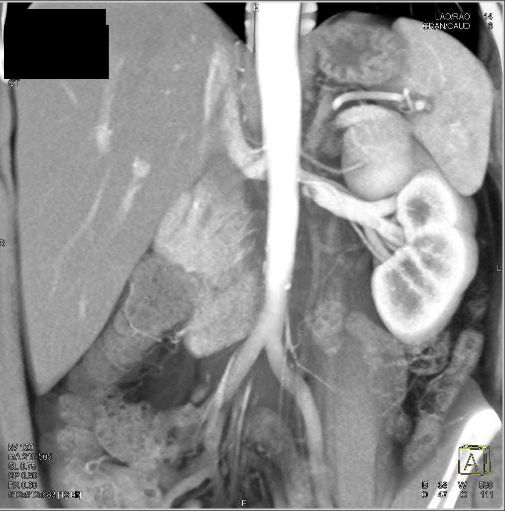 Multiple Left Renal Arteries Nicely Defined in a Potential Renal Donor - CTisus CT Scan