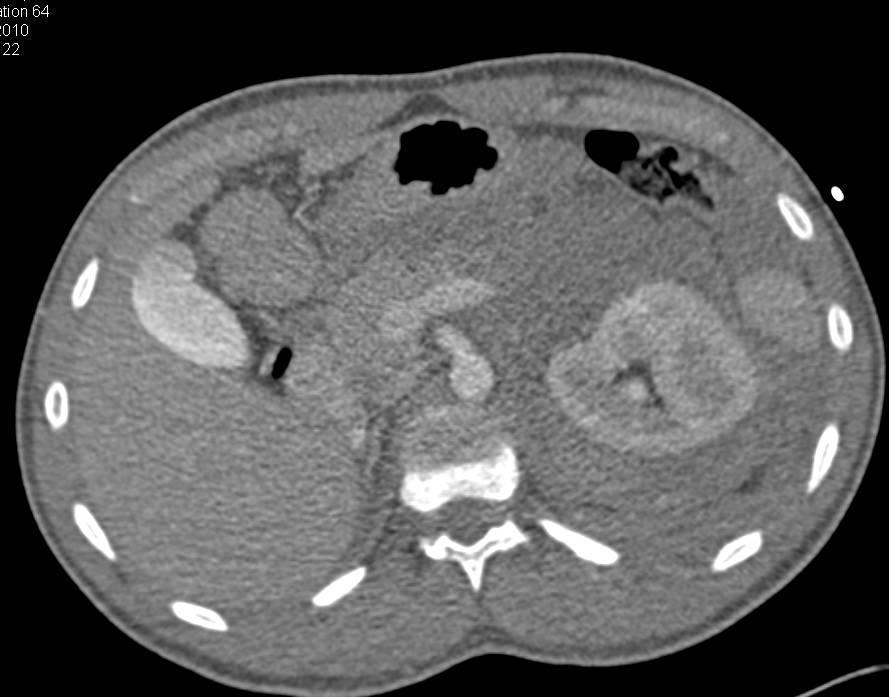 Renal Laceration with Perirenal and Pararenal Bleed - CTisus CT Scan