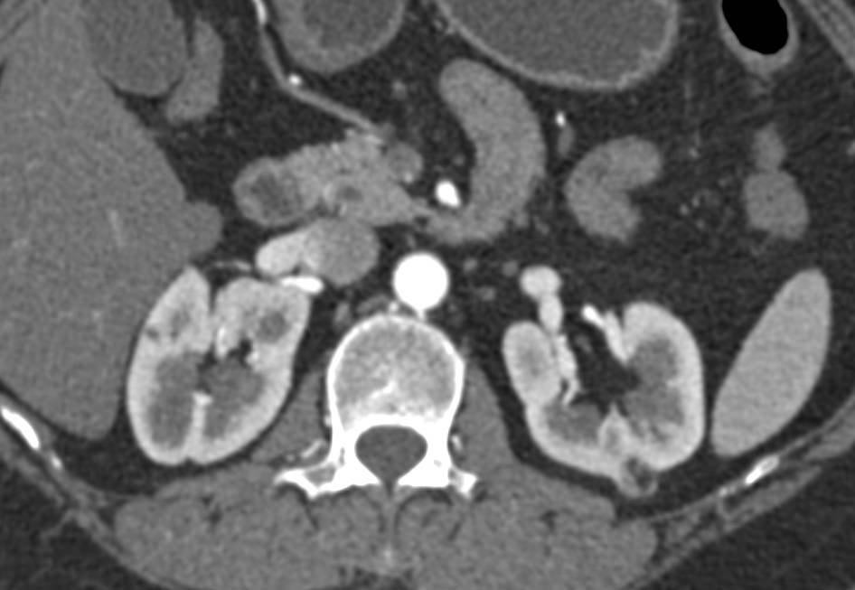 Duplicated Collecting System Left Kidney with an Incidental Left 1 cm Angiomyolipoma - CTisus CT Scan