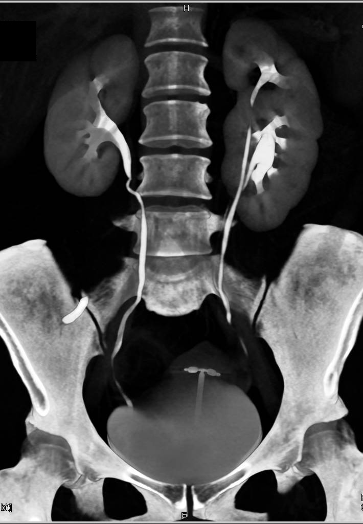 Duplicated Collecting System Left Kidney with an Incidental Left 1 cm